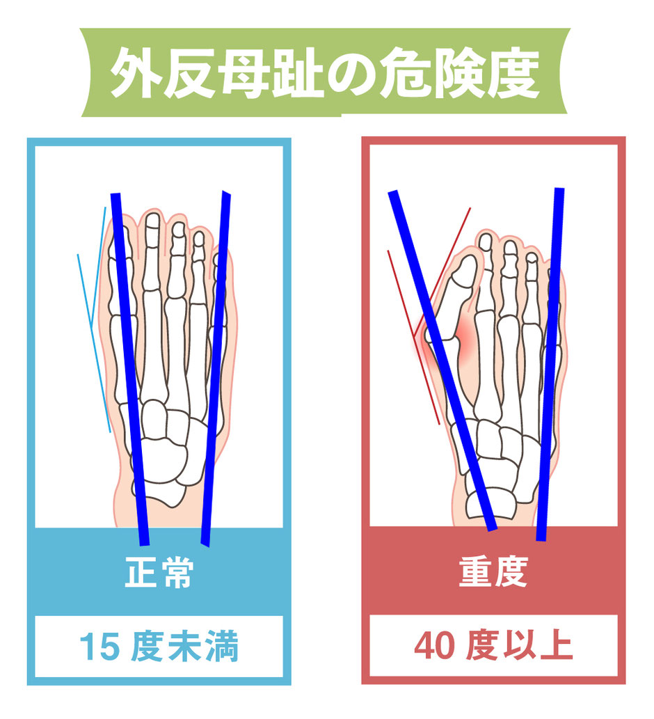 外反母趾とMP関節の横幅の広がりを示す画像
