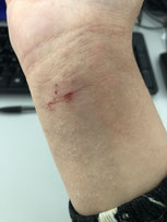 eczema lichenifie poignet