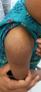 eczema sur peau  noire dépigmentation 