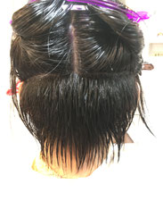 施術中写真