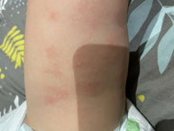 eczema rouge