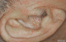 dermite seborrheique de l oreille