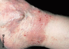 eczema variqueux