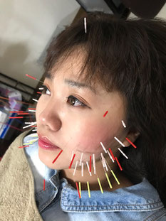 小牧 鍼治療 鍼灸 腰痛 頭痛 自律神経 美容鍼