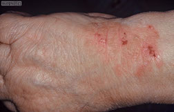 eczema lichenifie