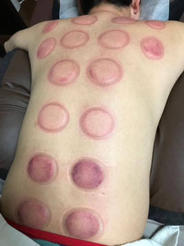小牧 吸い玉 カッピング デトックス
