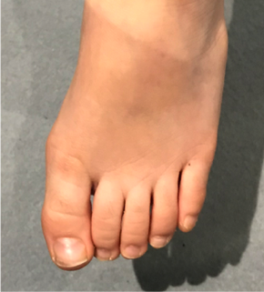 hallux valgus chez l'enfant