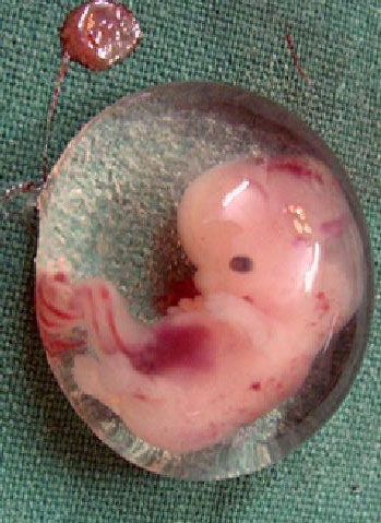 Embrione di 5-6 settimane espulso con la RU486