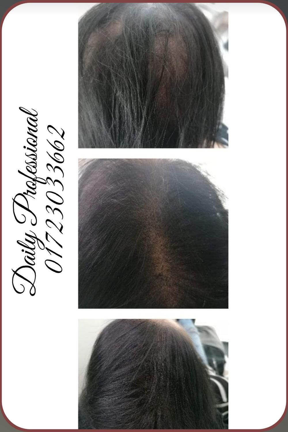 Micro Haarpigmentierung (Verdichtung  vorher/nachher)
