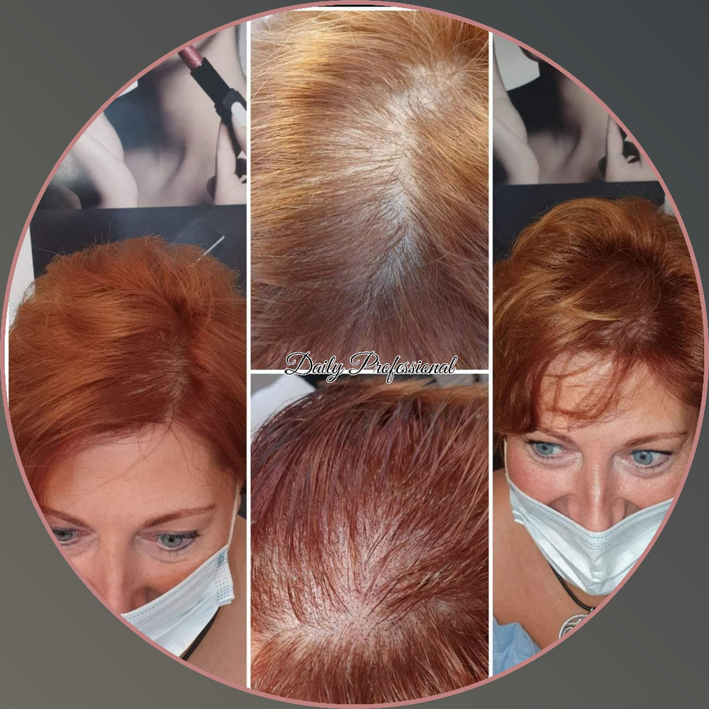 Micro Haarpigmentierung (Verdichtung  / vorher/nachher)