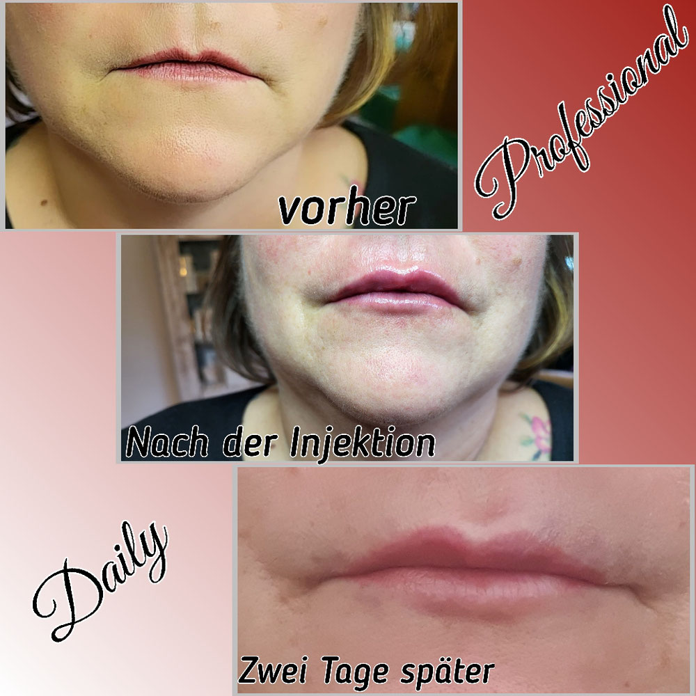 Hyaluron Injektion 1ml 