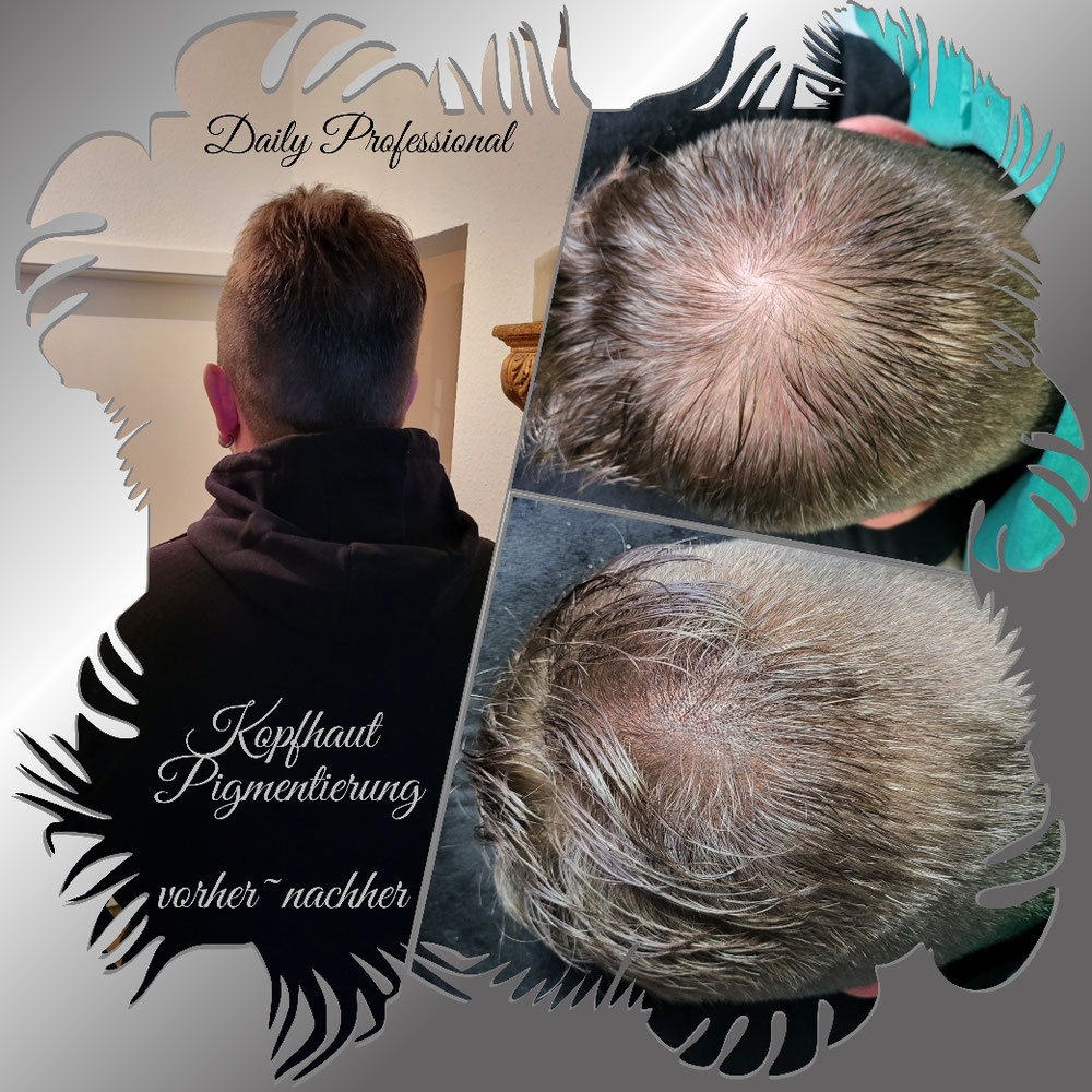 Microhaarpigmentierung/ Verdichtung 