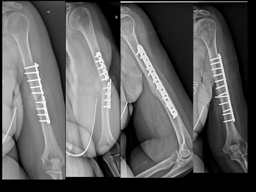 FRACTURE DE L'HUMÉRUS Dr Rémi chirurgien orthopédiste à Toulouse