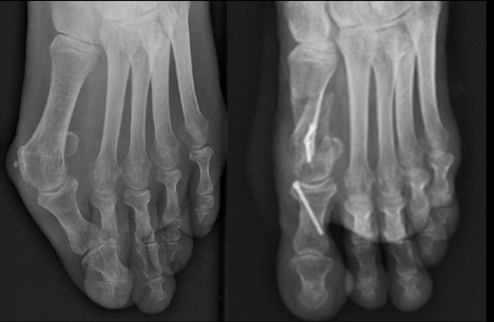 LES SUITES OPERATOIRES DE L'HALLUX VALGUS Dr Rémi chirurgien — free download
