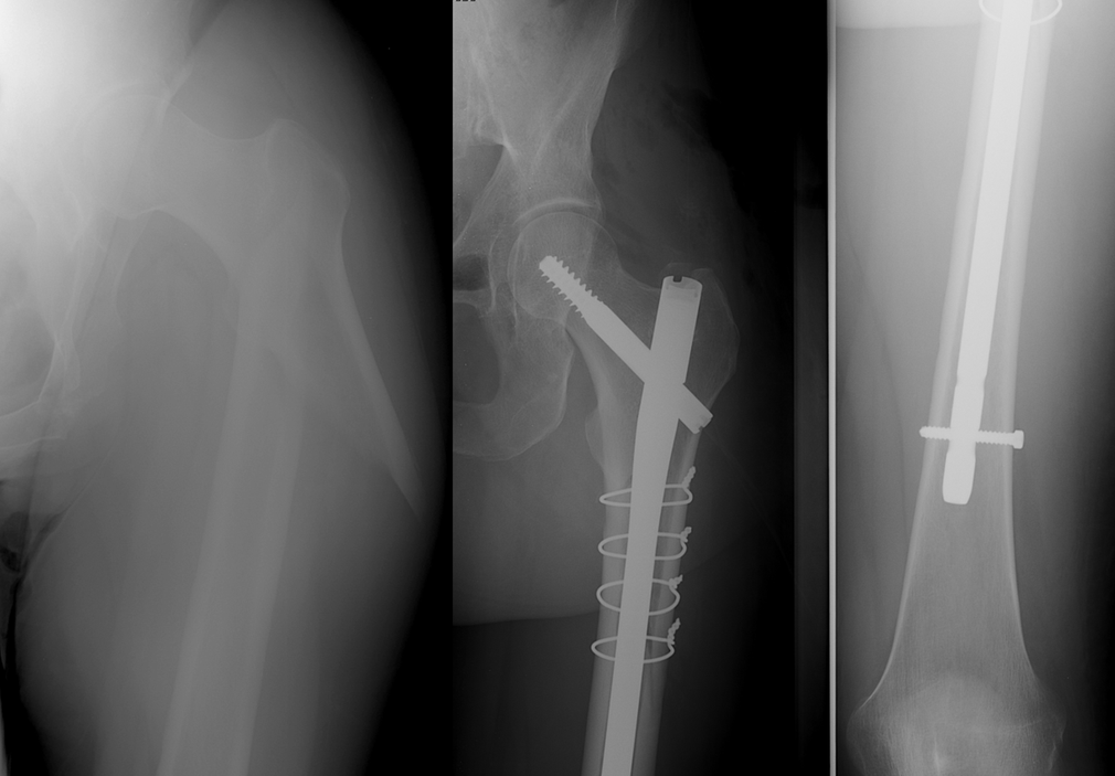 FRACTURE HANCHE - Dr Rémi : chirurgien orthopédiste à Toulouse