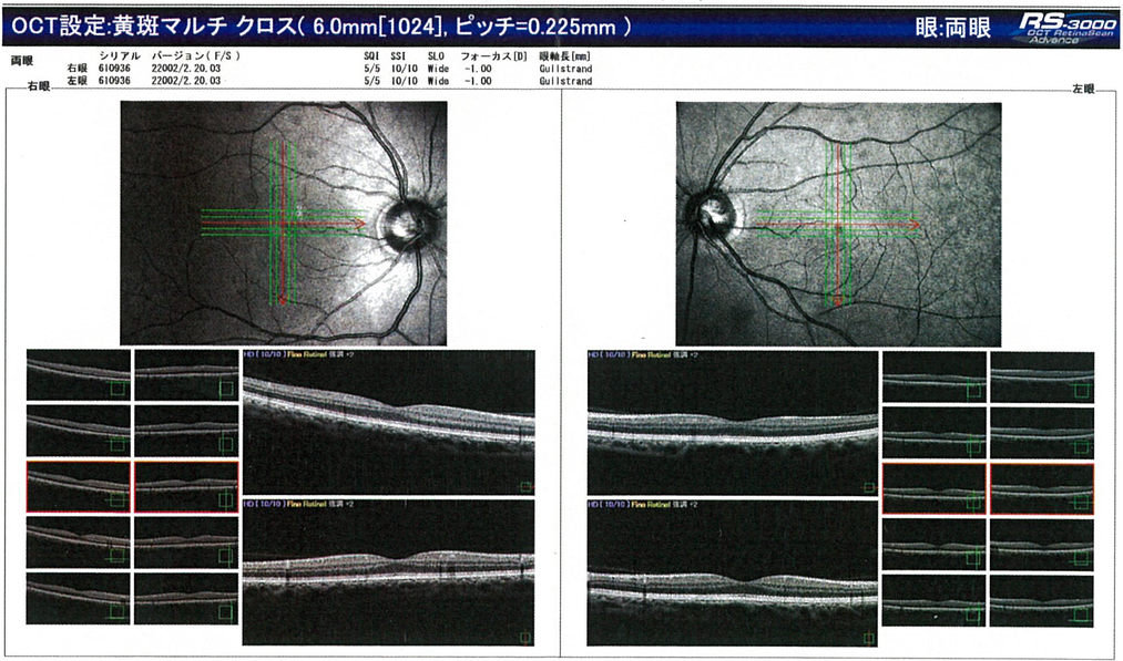 OCT（光干渉断層計）検査の結果②