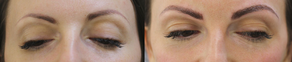 Microblading über altes PMU. Rote Farbe war in der Haut zurück geblieben.