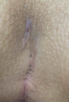Sinus pilonidalis with multiple pits - proctology berlin
