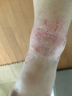 乳児湿疹やアトピーのかゆみ止めにステロイドなしで治る方法 子供のアトピーの原因がわかりステロイドなしで治る方法