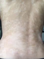 Photo eczema avec taches blanches