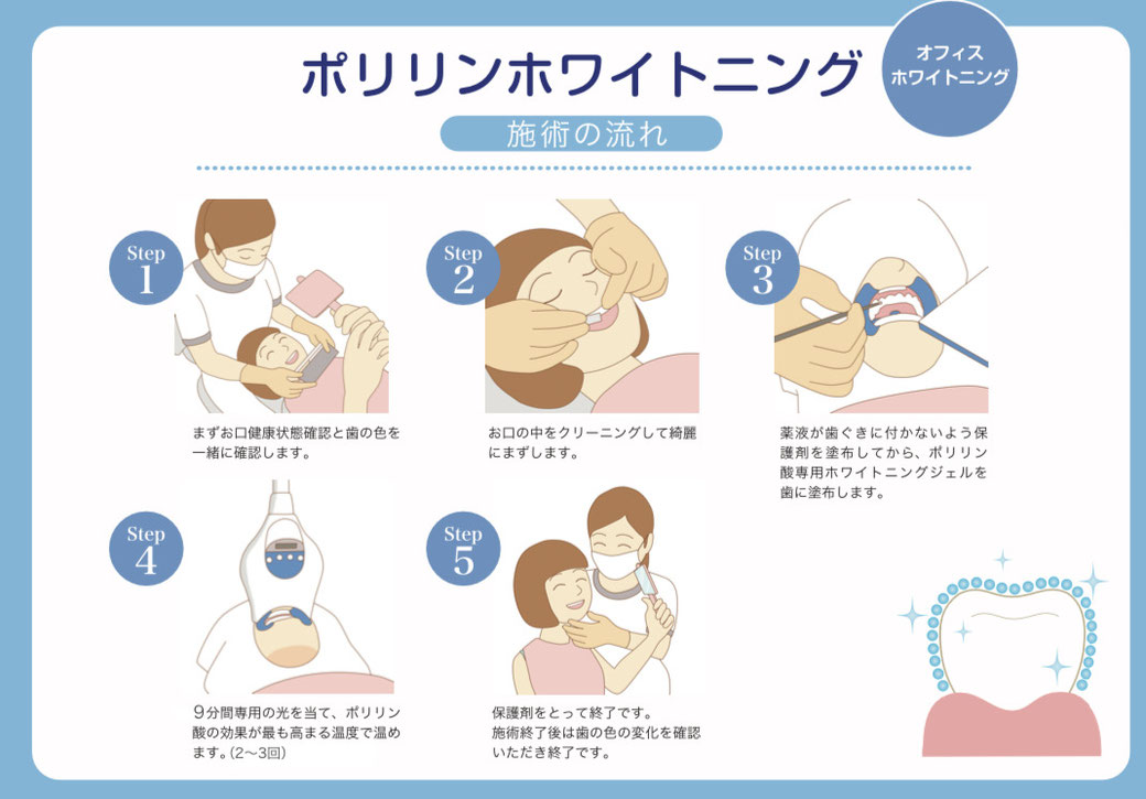 ポリリンホワイトニング施術の流れ