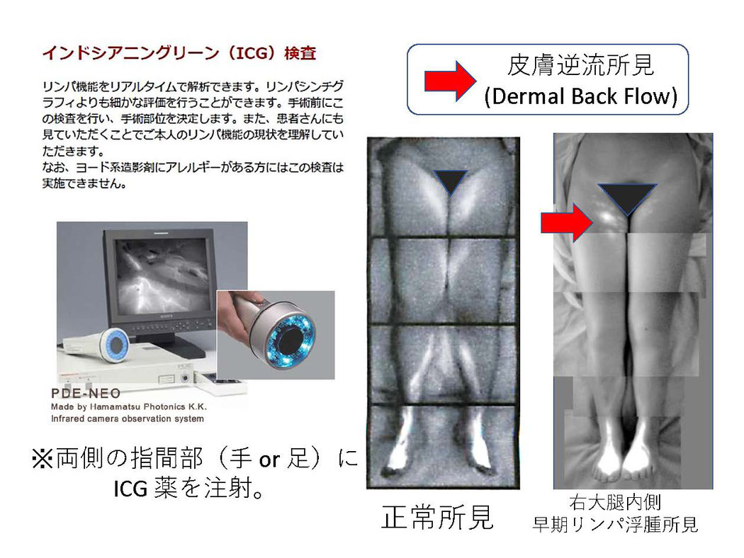 早期　予防　LVA　リンパ浮腫　子宮癌　乳がん　乳癌　治療　保存療法　リハビリテーション　専門医　三原誠