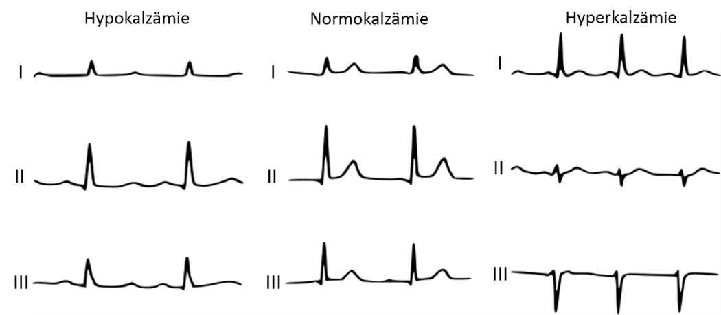 EKG bei Elektrolytstörungen - Fokus-EKG
