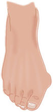 Hallux Valgus