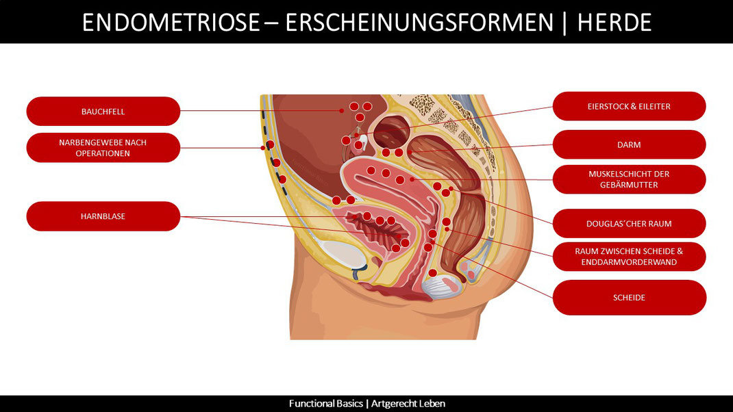 Östrobolom & Endometriose