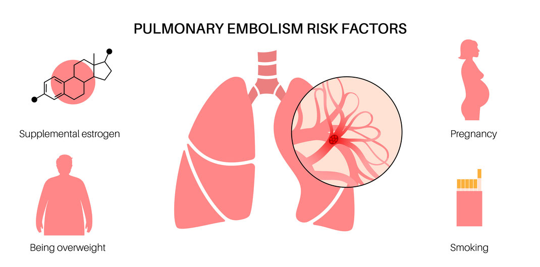 Risk of pulmonary embolism
