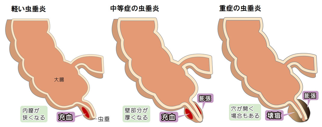 急性虫垂炎 茨木市の小児科 はら小児科クリニック