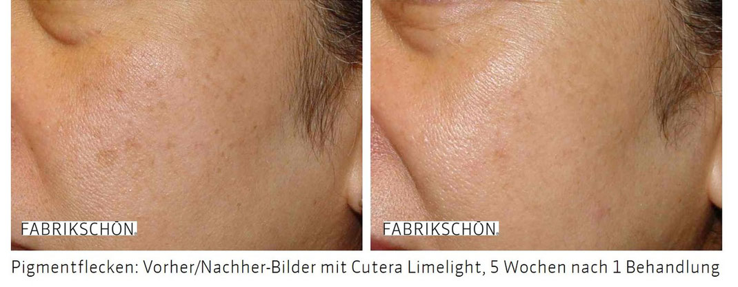 Dass von den Pigmentflecken anstreichen