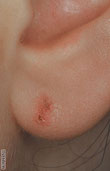 photo d'un eczéma allergique tige boucle oreille