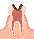 歯の神経まで進んだ虫歯のイラスト図