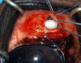 Ciclosporin Implantat