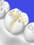 Zahn Versiegelung Fissurenversiegelung