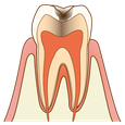 五反田　歯科　たかす歯科クリニック虫歯
