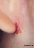 photo d'une coupure sous l oreille typique de l'eczéma atopique