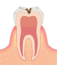 歯の神経に近い虫歯のイラスト図