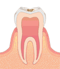 削る必要のないごく初期の虫歯のイラスト図