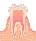 ごく初期の虫歯イラスト図
