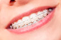 Zahnspangen vom Kieferorthopäden (Kfo) regulieren die Zähne