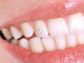 Zahnsteinchen als Zahnschmuck kosten wenig und sehen gut aus(© uwimages - Fotolia.com)