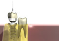 Mehr Lebensqualität: Zahnimplantate Sigmaringen
