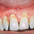 Aspetto clinico delle gengive in corso di parodontite: gengivite, recessioni gengivali, tasche parodontali e mobilità dentaria