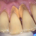 Accumuli di tartaro, una delle cause determinanti della parodontite