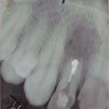 Radiografia dopo l' intervento