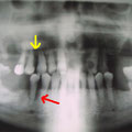Riassorbimento osseo orizzontale (freccia gialla) e verticale (freccia rossa) in paziente affetto da parodontite