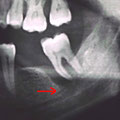Grossa tasca parodontale in stretta contiguità con il canale mandibolare