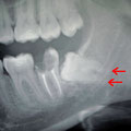 Dente del giudizio in inclusione osteo-mucosa, gli apici delle radici sono sovrapposti al canale mandibolare